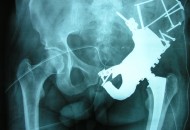 Pelvis_Replacement x-ray