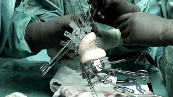 Operation mit dem Allograft Kniesystem in der MHH Hannover